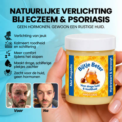 Bijtje Beter – Hormoonvrije balsem voor eczeem & psoriasis